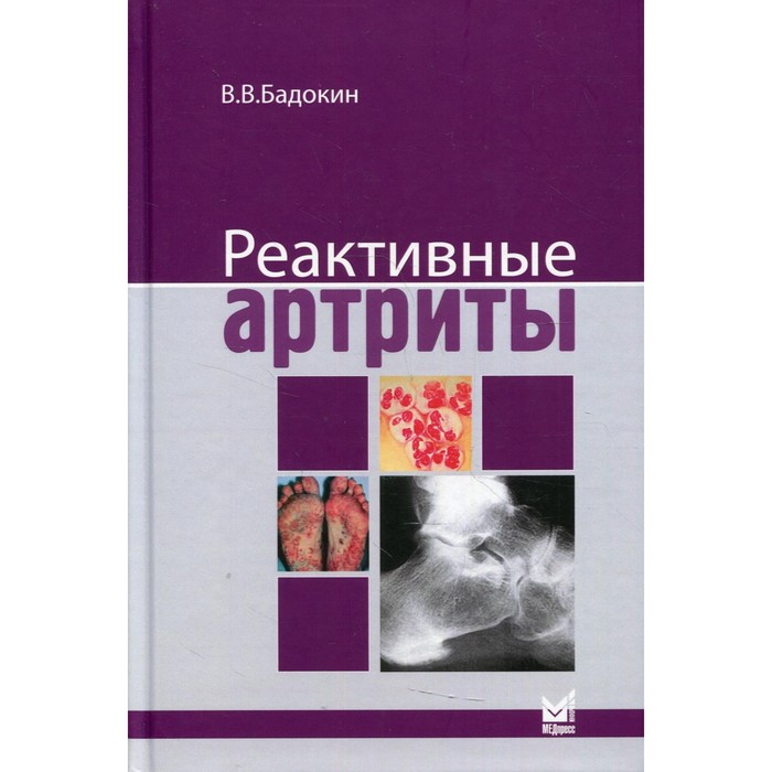 

Реактивные артриты. Урогенитальные и постэнтероколитические. Бадокин В.В.