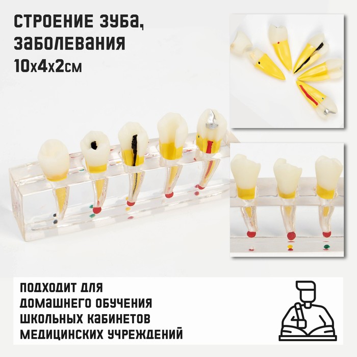 

Макет "Строение зуба, заболевания", 10*4*2см