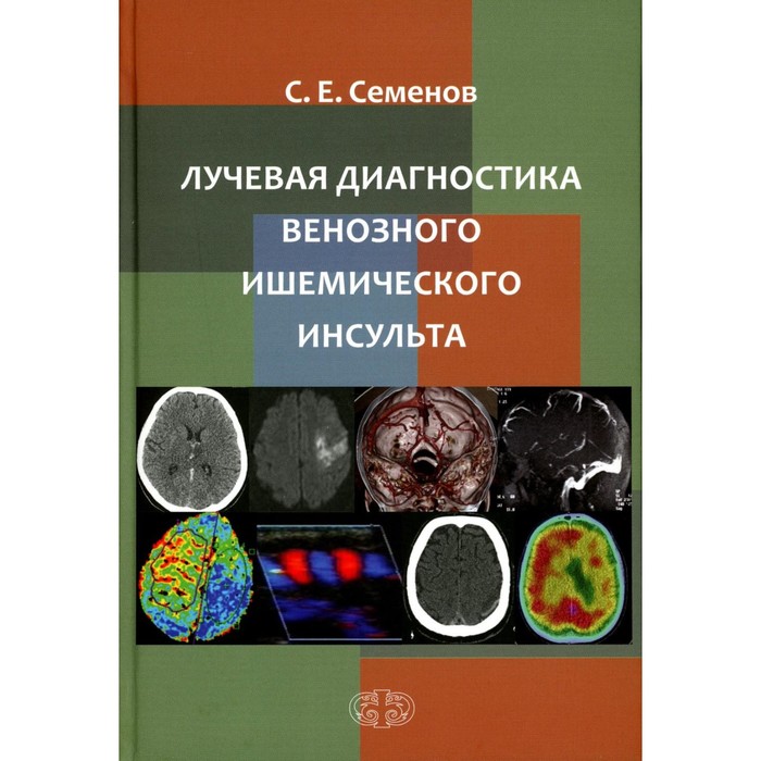 Лучевая диагностика венозного ишемического инсульта. Семенов С.Е. кох б л лучевая диагностика голова и шея