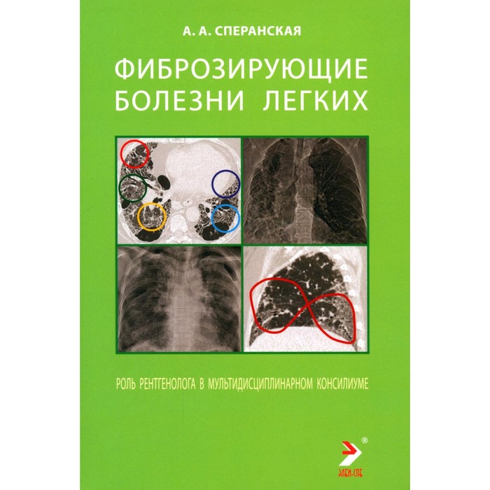 

Фиброзирующие болезни лёгких. Роль рентгенолога в мультидисциплинарном консилиуме. Сперанская А.А.